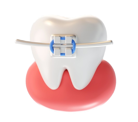 Braces in harlur Bangalore