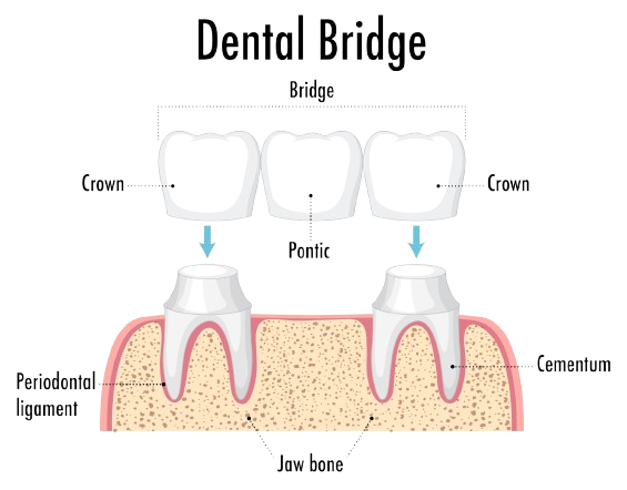 Dental Bridge in harlur