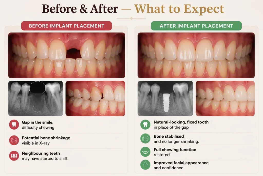 Dental Implant Treatment Result in harlur