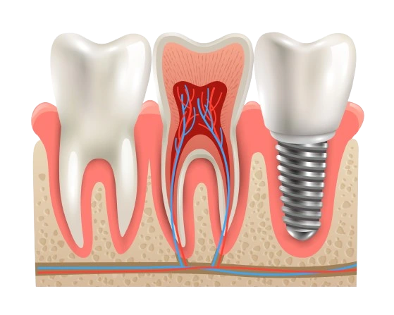 Dental Implants in Harlur Bangalore