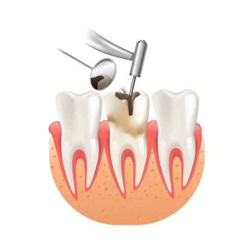 Dental_Fillings_in_Harlur_Cavity_Treatment