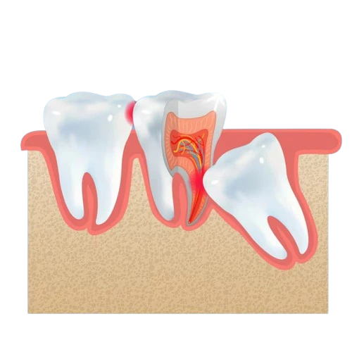 Wisdom Tooth Removal in Harlur _Bangalore