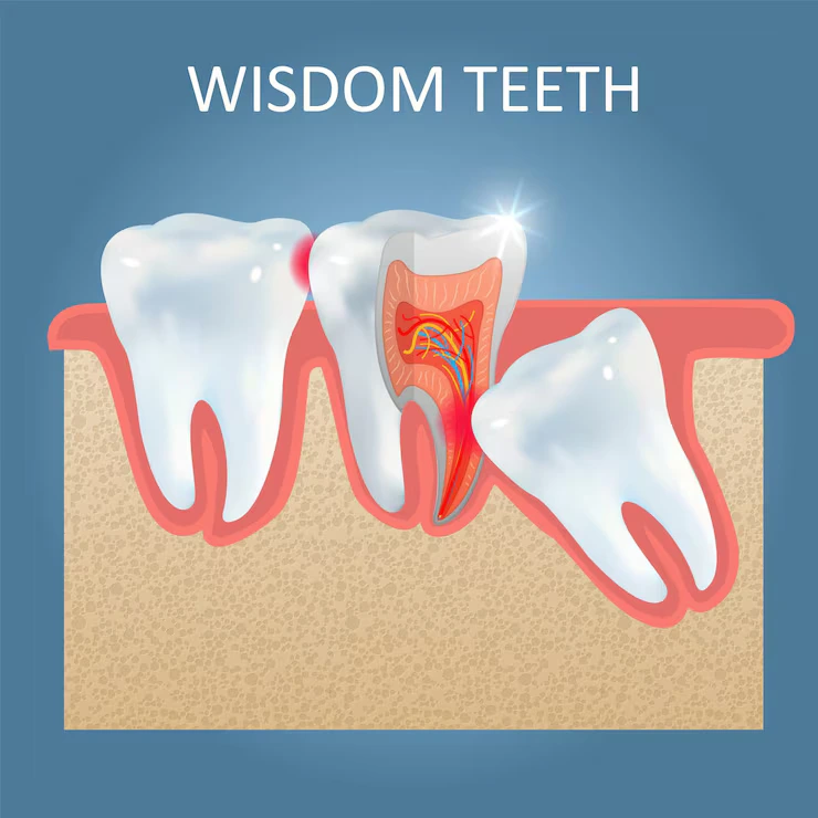 Wisdom Tooth Removal in Harlur ​Bangalore