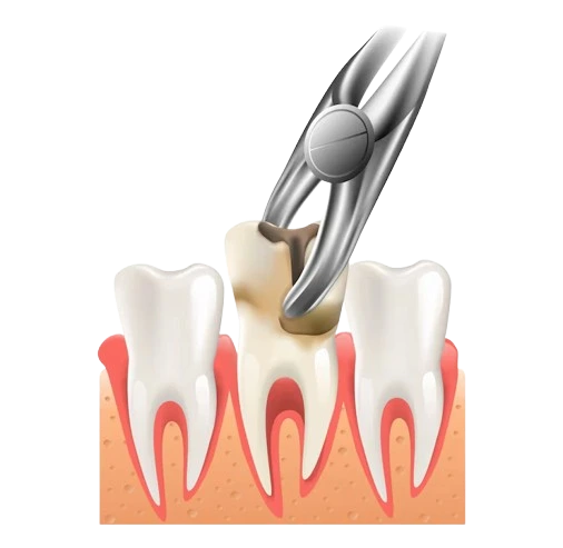 tooth extraction in Harlur