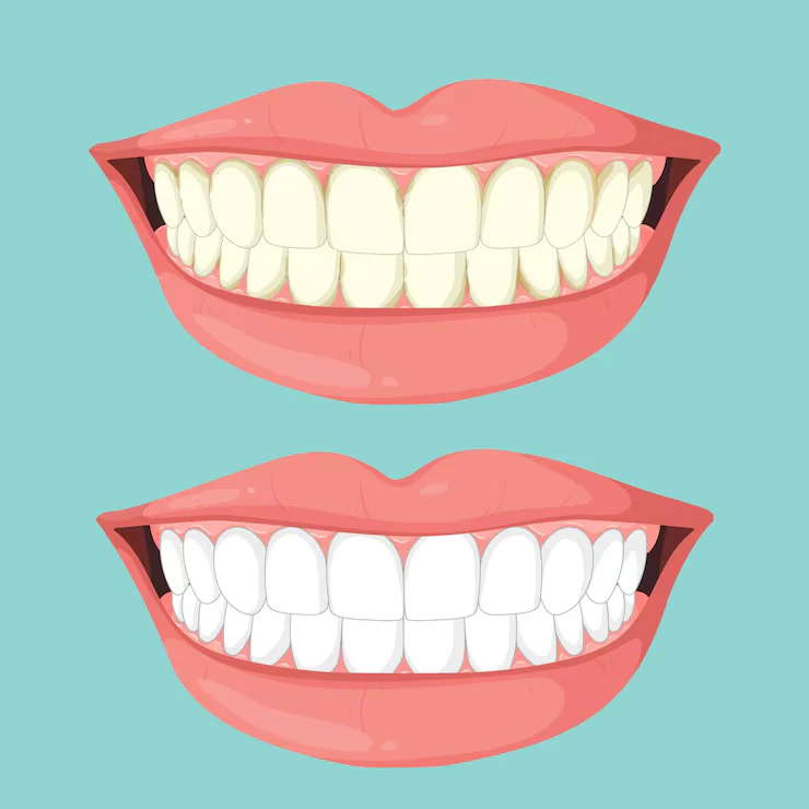 Smile Makeover in Harlur Bangalore