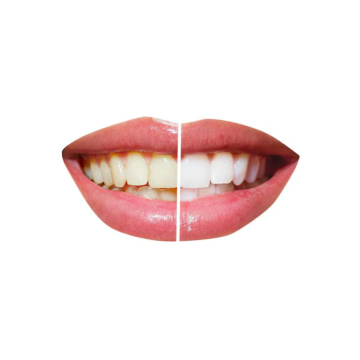 Teeth Whitening in Harlur
