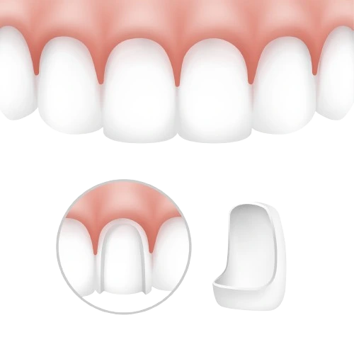 Veneers In harlur